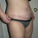 6 weeks po.  Scar is getting better.  I can cover it with almost all underwear and soon with bathing suits too :)