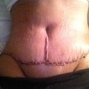 PODay 4 - close up of tummy scar and belly button