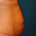 Before & after.  4 weeks post op.