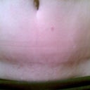 See! There is hope for THE SCAR!!! :)