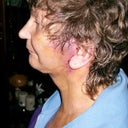 Hole that was left on the left side of face where he did not attach ear lobe properly