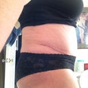 4 weeks PO Right side