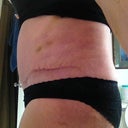 4 weeks PO Left side