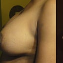 Left comparison photos: pre-op, 3 weeks and 9 weeks.