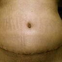 Day 10 PO. Today's belly button shot. Swelling more on my left than right and bb still has some crustiness left to clear up.