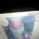A bad pic..but this is before surgery.