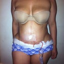10 days post op- a lot of swelling