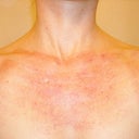 the day after treatment