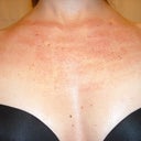 5 days after treatment