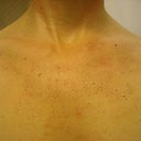 10 days after treatment
