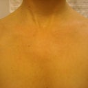 3 weeks after treatment (optimal results)