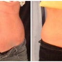 Left: Before. Right: 8 weeks after the first round of coolsculpting on abdomen and flanks. I don't see a very noticeable difference from the front (perhaps my abs look a little flatter?). I don't think this treatment worked on my flanks at all. To me, my sides don't look any different in the after photo then they do in the before...