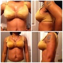 The pictures on top are from New Years and the bottom I are from today Jan 10... They have started to drop and swelling has went down a lot. On the bottom pics you can see my straps are pulled tighter and they are not so high on the second pic.. Making progress.. ;)