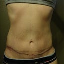3 Weeks PO.  Swelling continues to go down :)