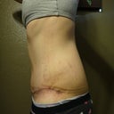 3 Weeks PO Left Side