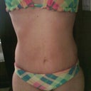 Another bikini at 3 Weeks PO
