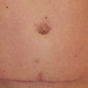 After my 2nd TT.  Longer scar, but pretty straight, thanks Doc :).  And healing is gowing great...I cant say enough about a product called SCARAWAY, you can find easily on Amazon.com.  I have been using ScarAway for 11 weeks, 24 & 7...they suggest 12 weeks but I will try probably double that.  Also this picture was taken April 15, 2012...4 months after my surgery.  Now I think thats a pretty good 4 month scar :)!