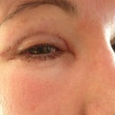 Picture of swollen eye 9 days post op