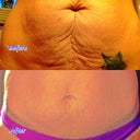 Before & After at 24 hours post op