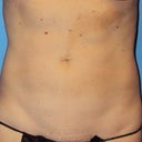 Liposuction