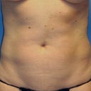 Liposuction