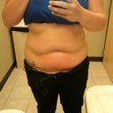 After my first procedure on my lower abdomen. I also had my upper abdomen done.