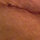 this is the side that was quite puffy. It is by far the uglier looking part of my scar. this is my right hip