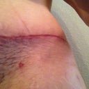 Left hip, see how nice and flat the scar is