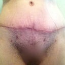 full view of the scar. ignore the pubes jungle I got going on