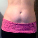 Day after procedure, pretty swollen.
