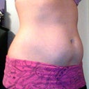 Day after procedure, pretty swollen.