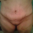 about 2 weeks post op can see the swelling and bruising