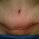 3 weeks post op looking better and better every day