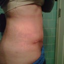3 weeks post op not as much swelling