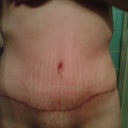 1 month post op