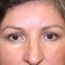 Forehead Lift, Brow Lift And Upper Eyelid Surgery