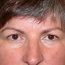 Forehead Lift, Brow Lift And Upper Eyelid Surgery