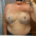 6 days post op. Feeling a lot better. Still some swelling in the right breast so it makes it look bigger & higher than the left. My incisions will be taped until I see the surgeon on June 13th.
