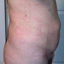 3 days after sirugy