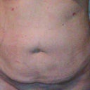 3 days after sirugy