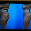 this is the before/after pic we put together during our pre-op visit