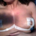 Post op- Day 5  6/9/12   (Sorry for the shadow)
