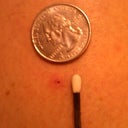 Entry Hole for laser after 14 days - is the size of the Q on the quarter with a little bit of pinkness left - all should disappear soon. Good work!