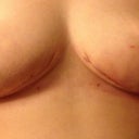 The swelling and bruising in my right breast (left in pic) is obvious here. Also the infected site is really red on my incision under the breast (right in the pic). It is looking much better though!