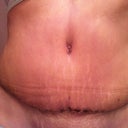 4 weeks PO today.  This is a pic of incision.