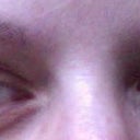 eyelid bulges like I'm crying
