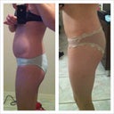left, 2 days before surgery, right is 3 months post op, this is my left side
