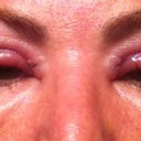 Third day - nice huh??! It didn't hurt at all.