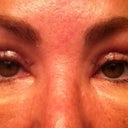 Seventh day right before suture removal