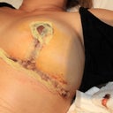 My new breast, 4 day post op